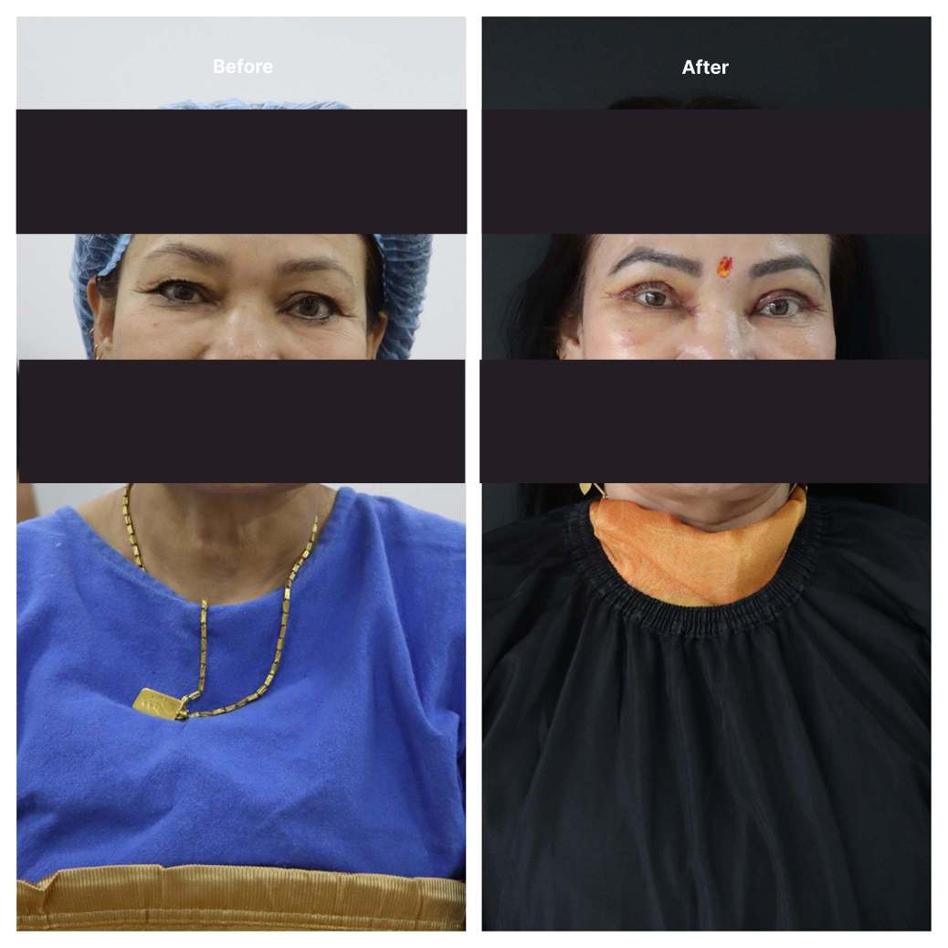 Eyelid Surgery KOQ10